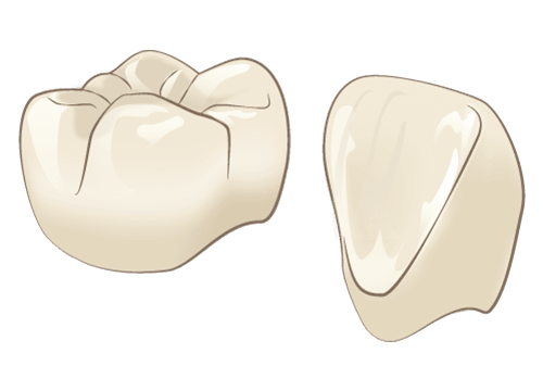 クラウン(被せ物)