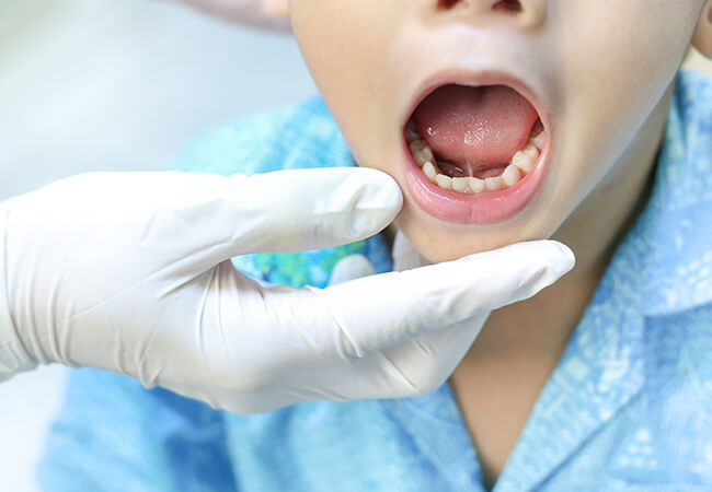 口腔機能発達不全症