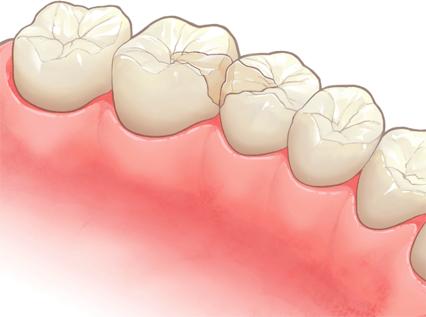 インレー(詰め物)